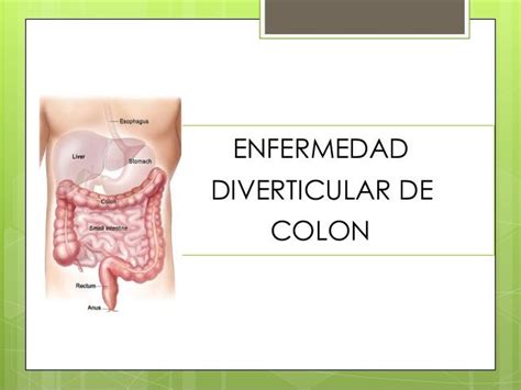 Enfermedad Diverticular De Colon