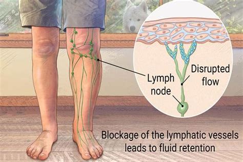 Treatment Of Lymphedema Effective Physiotherapy Clinic Abuja