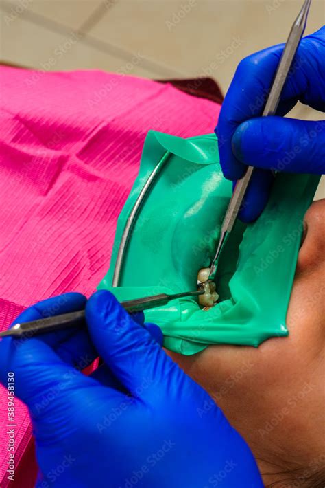 Dentist Treats The Tooth With Modern Methods Uses A Rubber Dam
