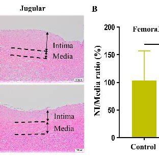 Inhibition Of Vein Graft S Neointimal Hyperplasia By Sirolimus Embedded