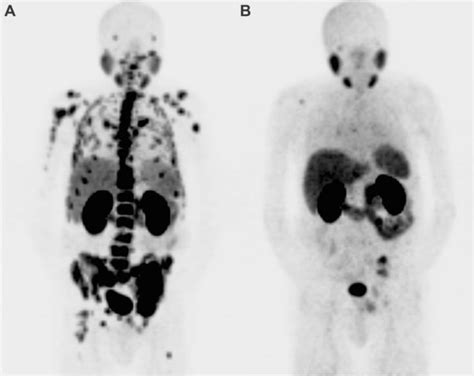 ⁶⁸GA PSMA PET CT before A and after B treatment with 6 cycles of