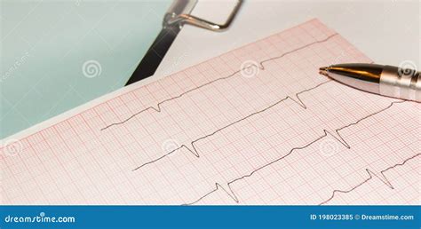 Heart Rate Result Graph Paper Document Electrocardiogram And Pen On It