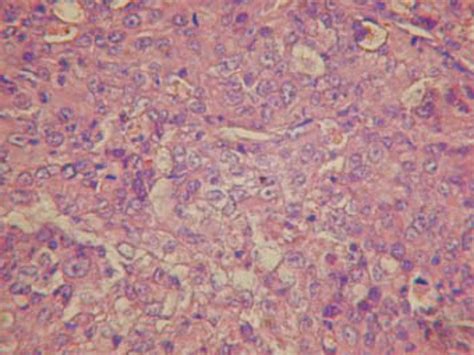 Presence of epitheloid cells and high mitotic activity. Tumorous tissue... | Download Scientific ...