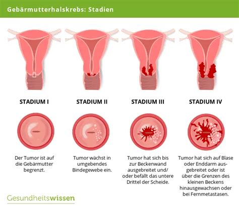 Gebärmutterhalskrebs Ursachen Symptome Behandlung