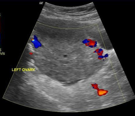 Ovarian Torsion Image Radiopaedia Org