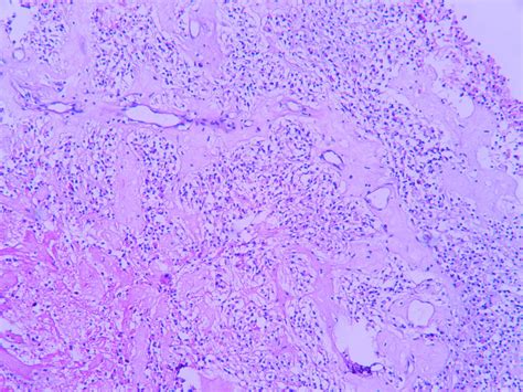 Anaplastic oligodendroglioma – Histopathology.guru