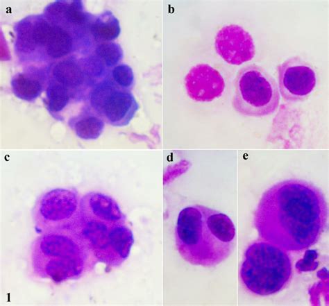 Urine Cytology Specimen From A Case Of Papillary Urothelial Neoplasm Of