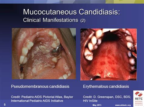 Guidelines For Prevention And Treatment Of Opportunistic Infections In