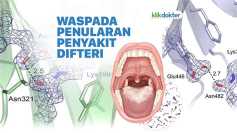 Hati Hati Begini Cara Penularan Penyakit Difteri KlikDokter