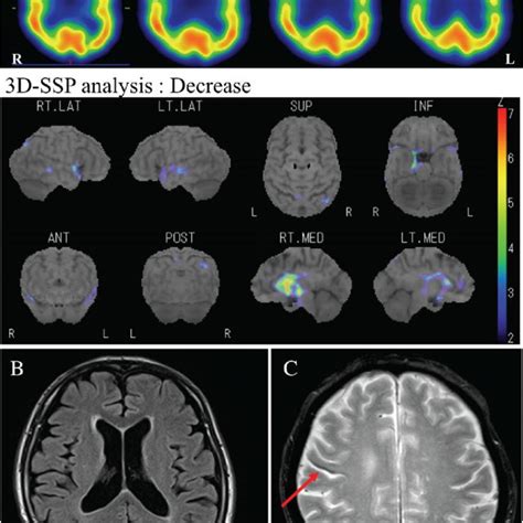 Neuropathological Findings Of The Brain And Spinal Cord A