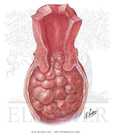 Sarcoma Botryoides Urethra