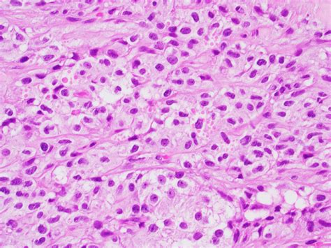 Pathology Outlines Sertoli Cell Tumor