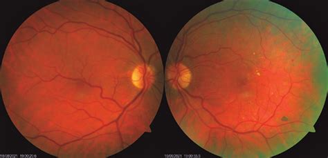 A Color Retinography Of The Right Eye Showing An Inferotemporal