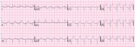 Dr Smith S Ecg Blog Chest Pain Sinus Tachycardia And St Elevation