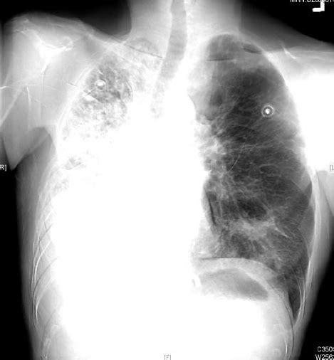 Posterior Anterior Chest Radiograph Obtained At Presentation To The