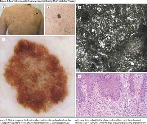 Pdf Multiple Braf Wild Type Melanomas During Dabrafenib Treatment For