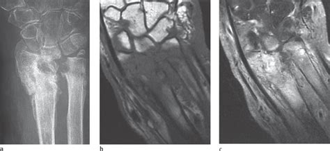 41 Osteomyelitis Radiology Key