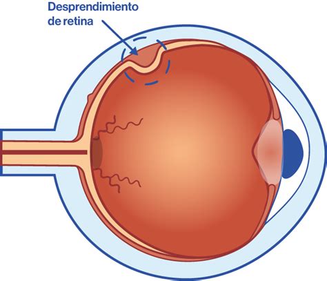 Definir plátano embargo señales de desprendimiento de retina