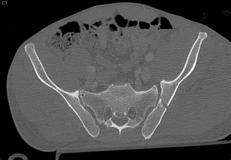 Complex Pelvic Fractures Including Sacrum Acetabulum And Femur With A Normal Ct Cystogram