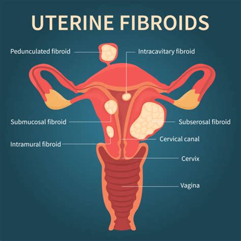 350 Uterine Fibroid Stock Illustrations Royalty Free Vector Graphics