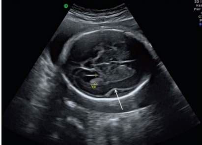 Lissencephaly: Diagnosis, Treatment and Prognosis