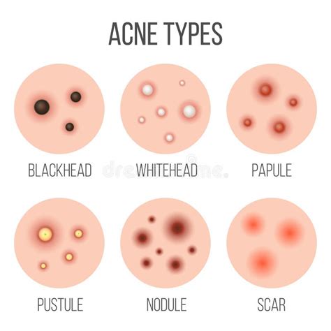 Acne Vulgaris Vector Design Stock Vector Illustration Of