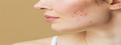 Manage And Treat Jawline Acne