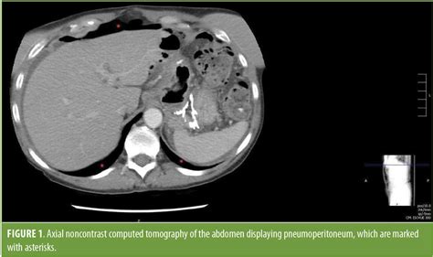 Marginal Ulcer Perforation And Concurrent 360 Degree Twisted Roux Limb