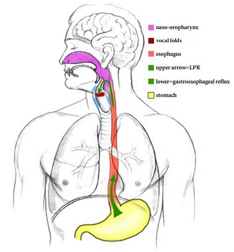 Laryngopharyngeal Reflux Test Homecare Medical