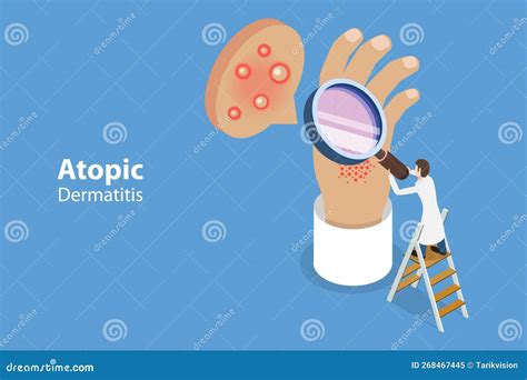 D Isometric Flat Vector Conceptual Illustration Of Atopic Dermatitis