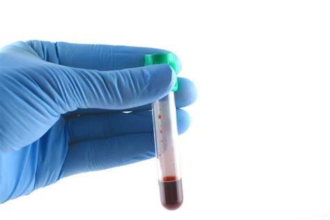 High Uric Acid Levels Hyperuricemia