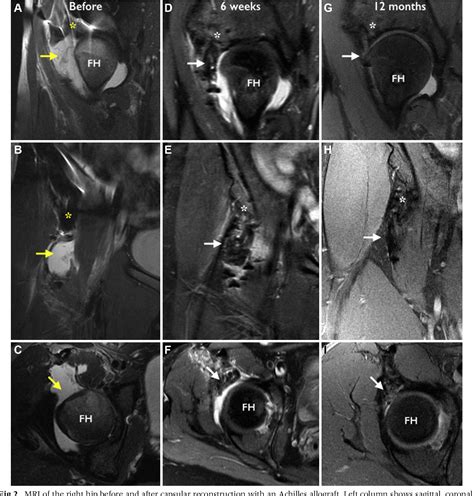 Figure 2 From Arthroscopic Anterior Capsular Reconstruction Of The Hip