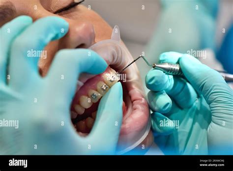 Braces Installation Hi Res Stock Photography And Images Alamy