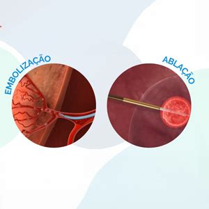 Ablação e embolização conheça as técnicas e suas diferenças