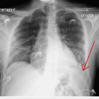 (A) AP chest X-ray on September 2021 prior to pericardial window ...