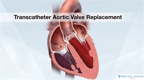 Trans Aortic Valve Replacement Surgery In Turkey Mct