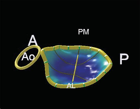 Mitral Valve Quantification Showed Dilated Mitral Valve Annulus