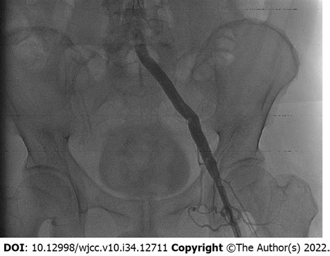 After Intravascular Embolization Digital Subtraction Angiography