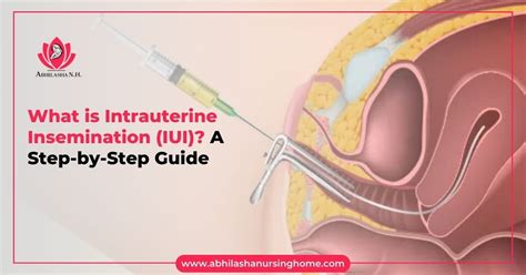 What Is Intrauterine Insemination IUI A Step By Step Guide