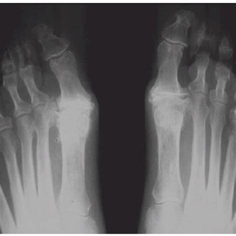 A standing X ray radiograph of a patient with bilateral hallux rigidus ...