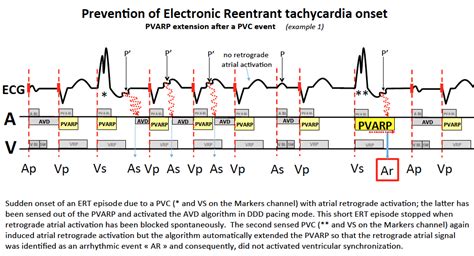 Refractory Periods Pmt Cardiocases