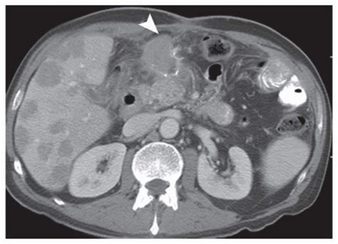 New Staging System for Gastric Cancer | Oncohema Key