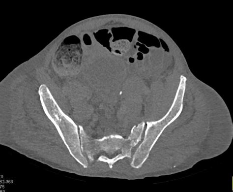 Multiple Myeloma Musculoskeletal Case Studies Ctisus Ct Scanning