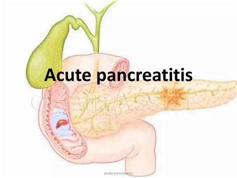 Acute Pancreatitis Ppt