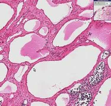 Histopathology Neck--Lymphangioma (cystic hygroma) - YouTube