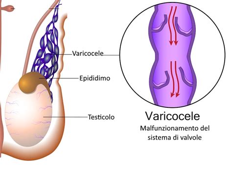 Varicocele Quinto Grado At Jerome Humphrey Blog