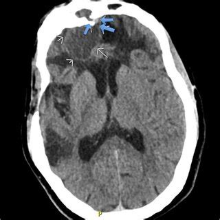 Axial View Of Initial Noncontrast Head Computed Tomography Showing