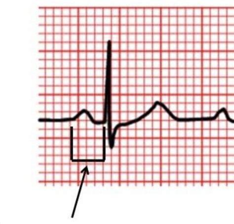 Ekg Monday Flashcards Quizlet