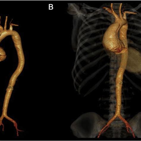 Baseline characteristics of patients with type B aortic dissection... | Download Scientific Diagram