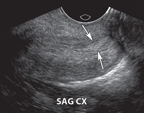 Cervical Polyps Ultrasound